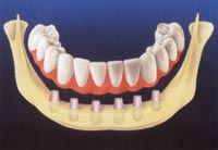 The permanent fixed denture is often an excellent alternative to removable dentures.