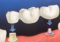 A fixed abutment or crown and bridge is often used when a crown can anchor the prosthesis in combination with an implant.