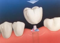 A single implant can be made when adjacent teeth are healthy and in place.